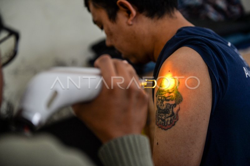 PROGRAM HAPUS TATO GRATIS DI BANDUNG ANTARA Foto PROGRAM HAPUS TATO GRATIS DI BANDUNG ANTARA Foto